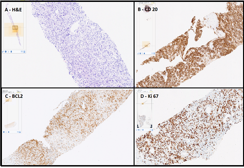 Spontaneous Remission in a High-Grade B-Cell Lymphoma