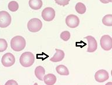 Microangiopathic Haemolytic Anaemia Induced by COVID 19