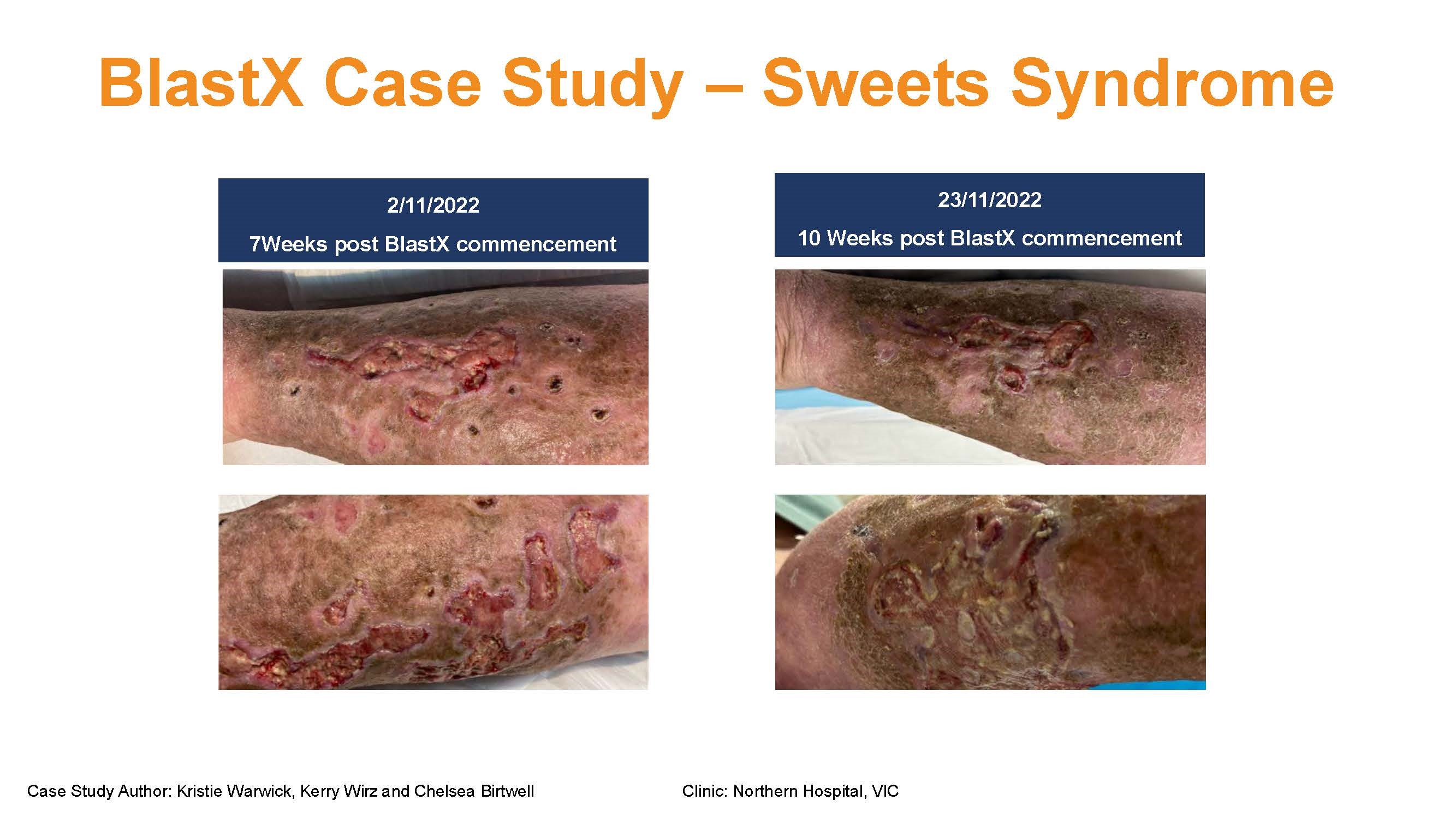 Case Report: BLASTX® Antimicrobial Wound Gel  Treatment in Sweets Syndrome with Lymphedema: A  Comp...