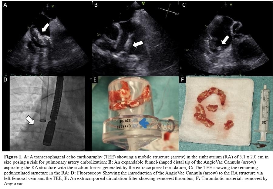 Percutaneous Removal of an Old Calcified Free-Floating Harmful Thrombus in a Patient with Severe Pul...