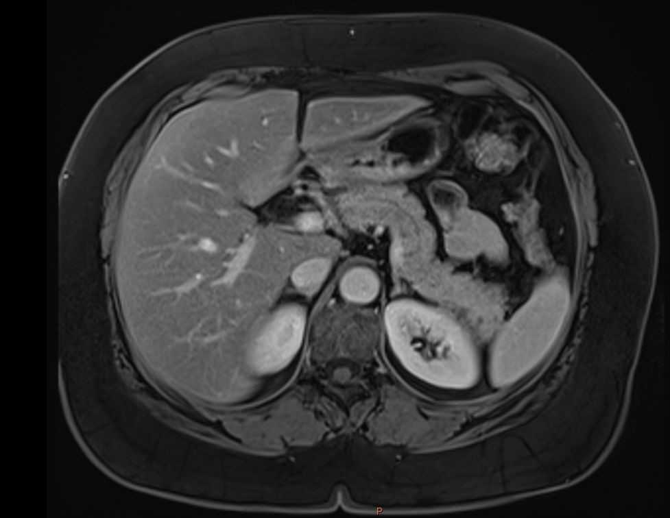 Unveiling Primary Aldosteronism in the Absence of Adrenal Morphological Abnormalities: A Case Report...