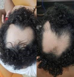 Intravenous Umbilical Cord Mesenchymal Stem Cell Therapy in Pediatric Alopecia Areata: A Case Report