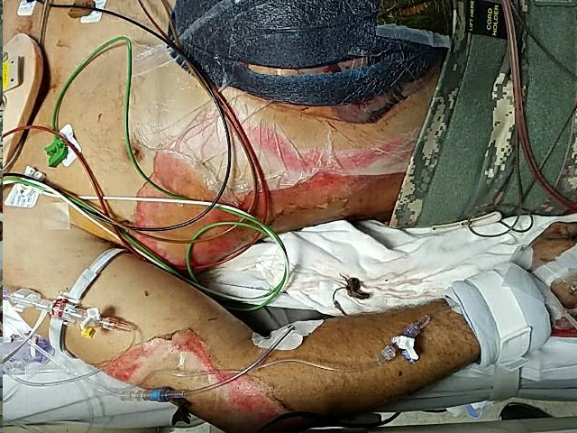 Disseminated Trichosporon asahii Infection in an Immunocompetent Polytrauma Patient; A Case Report