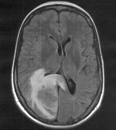 A Rare Case of Mannitol-Induced Anaphylaxis During Treatment of Cerebral Edema