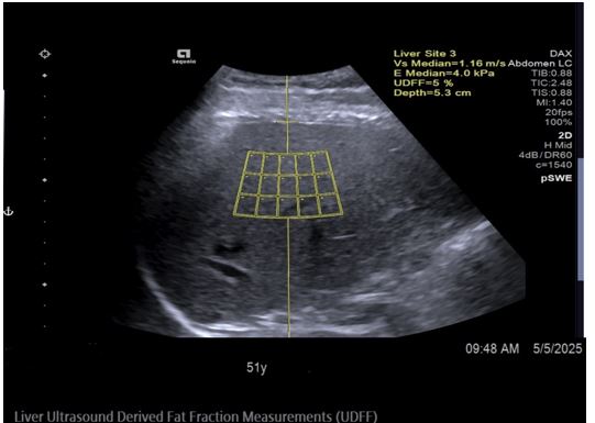 Ultrasound-Derived Fat Fraction (UDFF) for Monitoring Liver Steatosis in MASLD: A Case Report