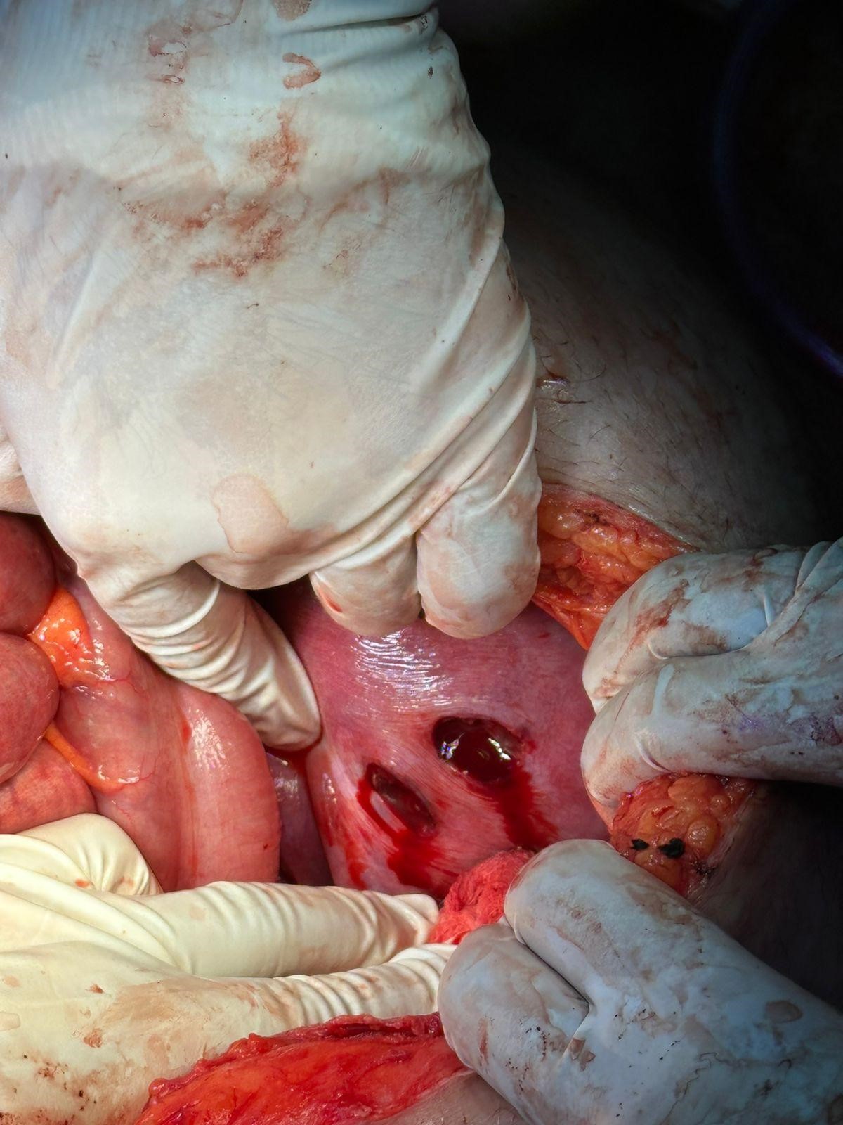 Penetrating Abdominal Trauma in Pregnancy Complicated by Aortic, IVC, and Uterine Injuries: A Rare C...